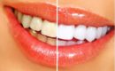 Как добиться белизны зубной эмали и предотвратить ее потемнение?
