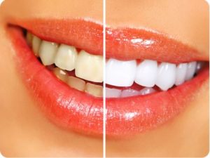 Как добиться белизны зубной эмали и предотвратить ее потемнение?