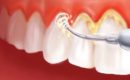 Отсутствие зубного камня – залог здоровой улыбки