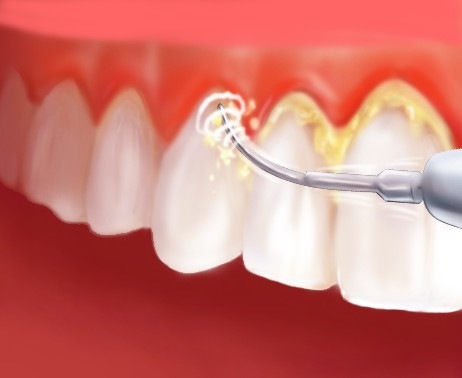 Отсутствие зубного камня – залог здоровой улыбки
