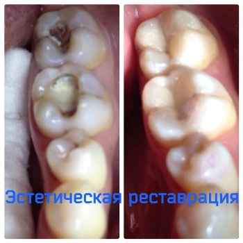 Лечение зубов в Казани